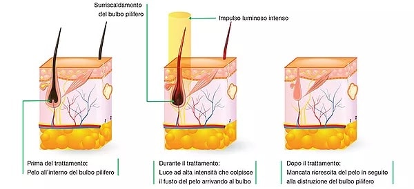laser a diodo noleggio e vendita Wellness Project Group