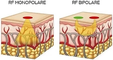 Radiofrequenza Wellness Project Group noleggio vendita macchinari estetici