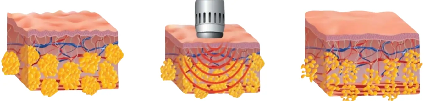 radiofrequenza noleggio e vendita Wellness Project Group