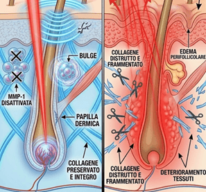 Frammentazione collagene post-epilazione laser